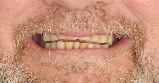 Heudy Before