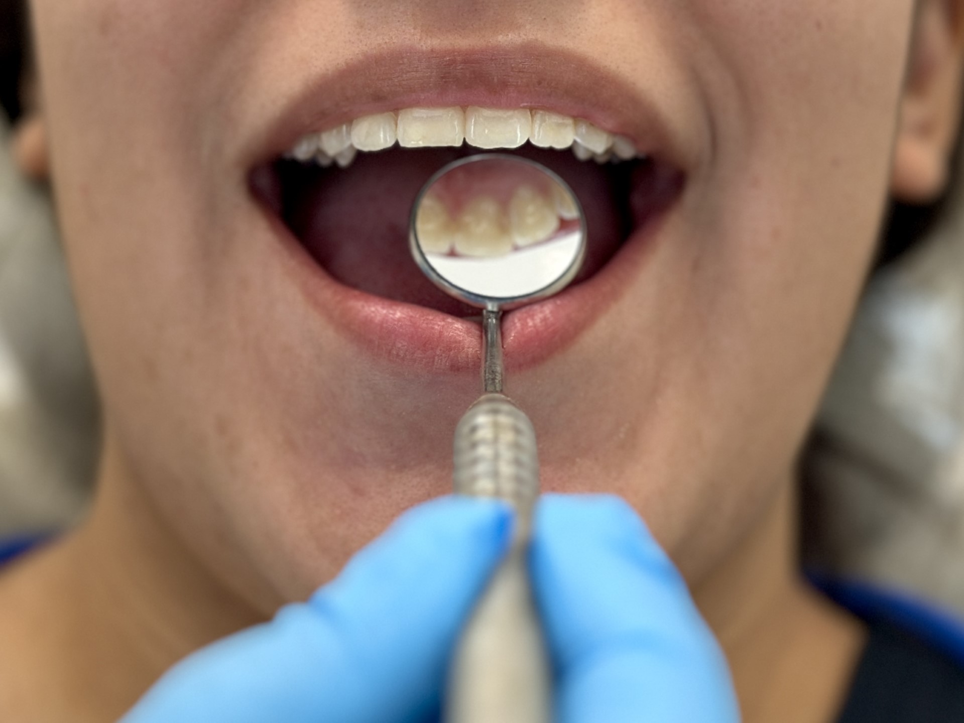 Close up of smile with a dental mirror underneath top teeth.