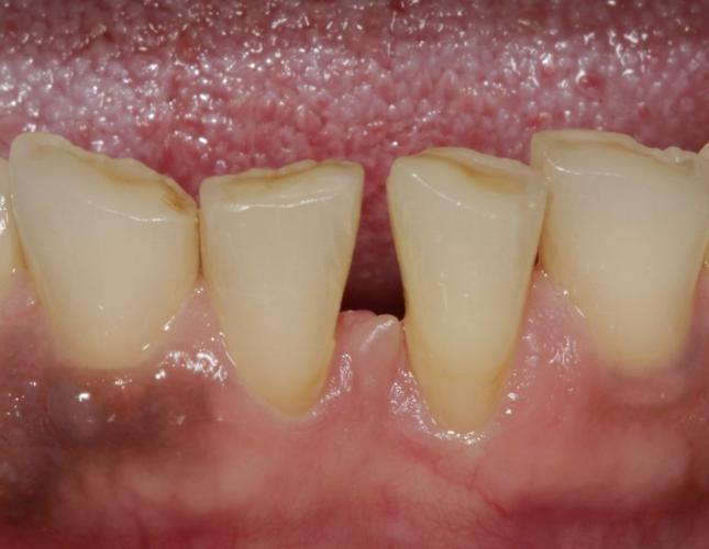 Colleen before