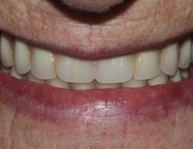 Emily before