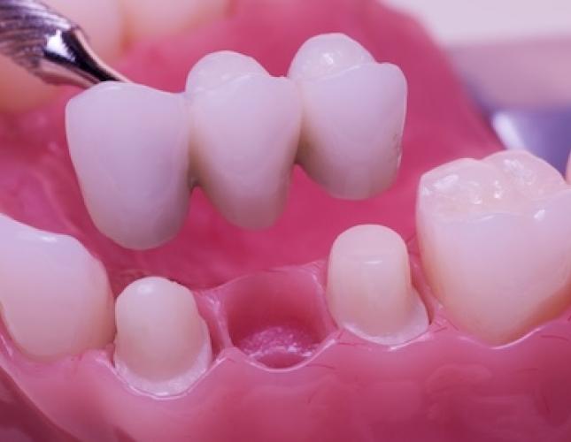Bridging the Gap: Understanding Dental Bridges in Restorative Dentistry
