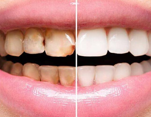 Caring for Restored Smiles: Tips for Long-lasting Dental Work