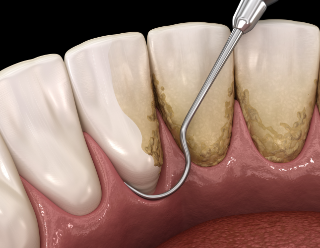 The Stages of Periodontitis: Understanding the Progression